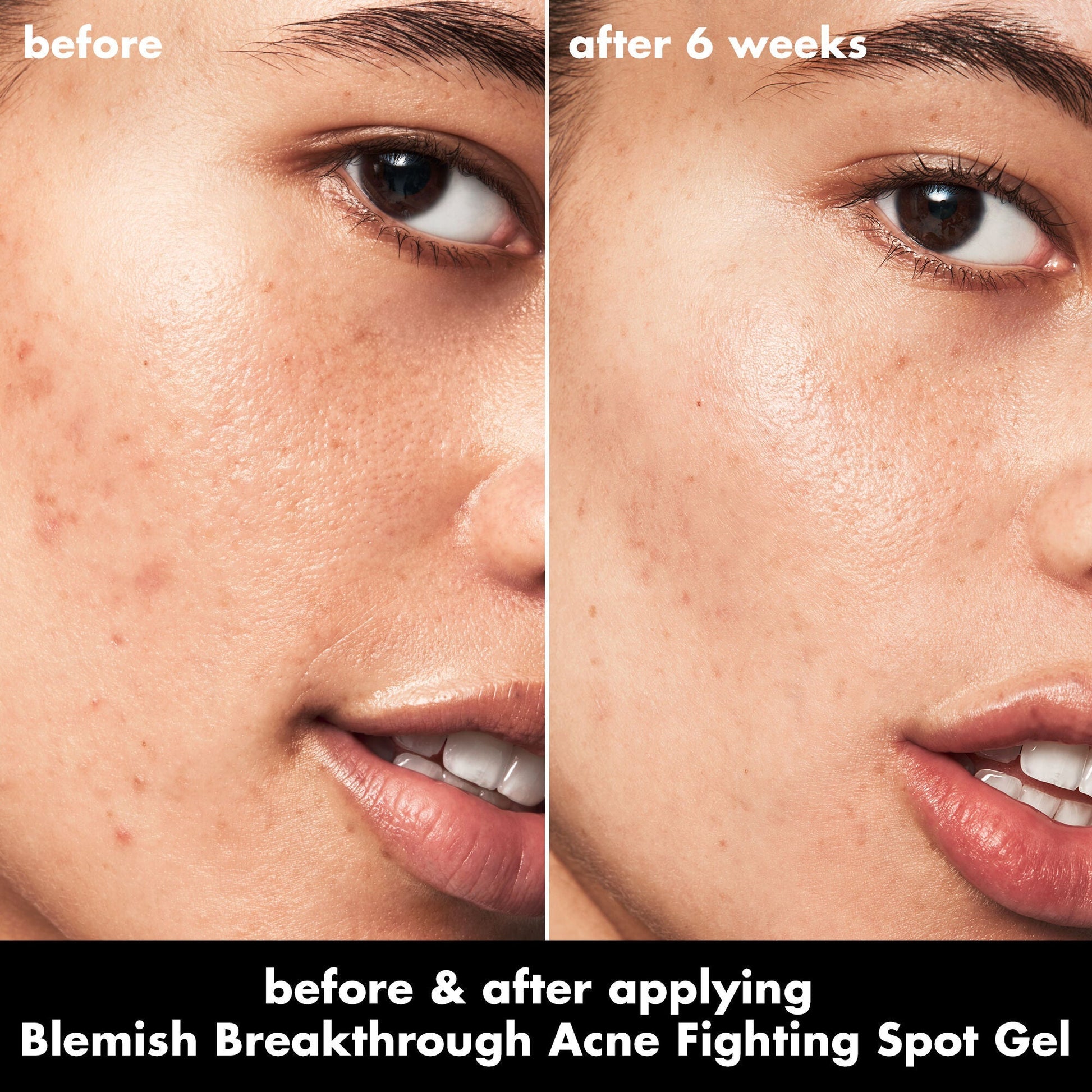 blemish-breakthrough-acne-fighting-spot-gel-n1 0326_EDU_BB_SpotGel_BA_ISABELLA.jpg