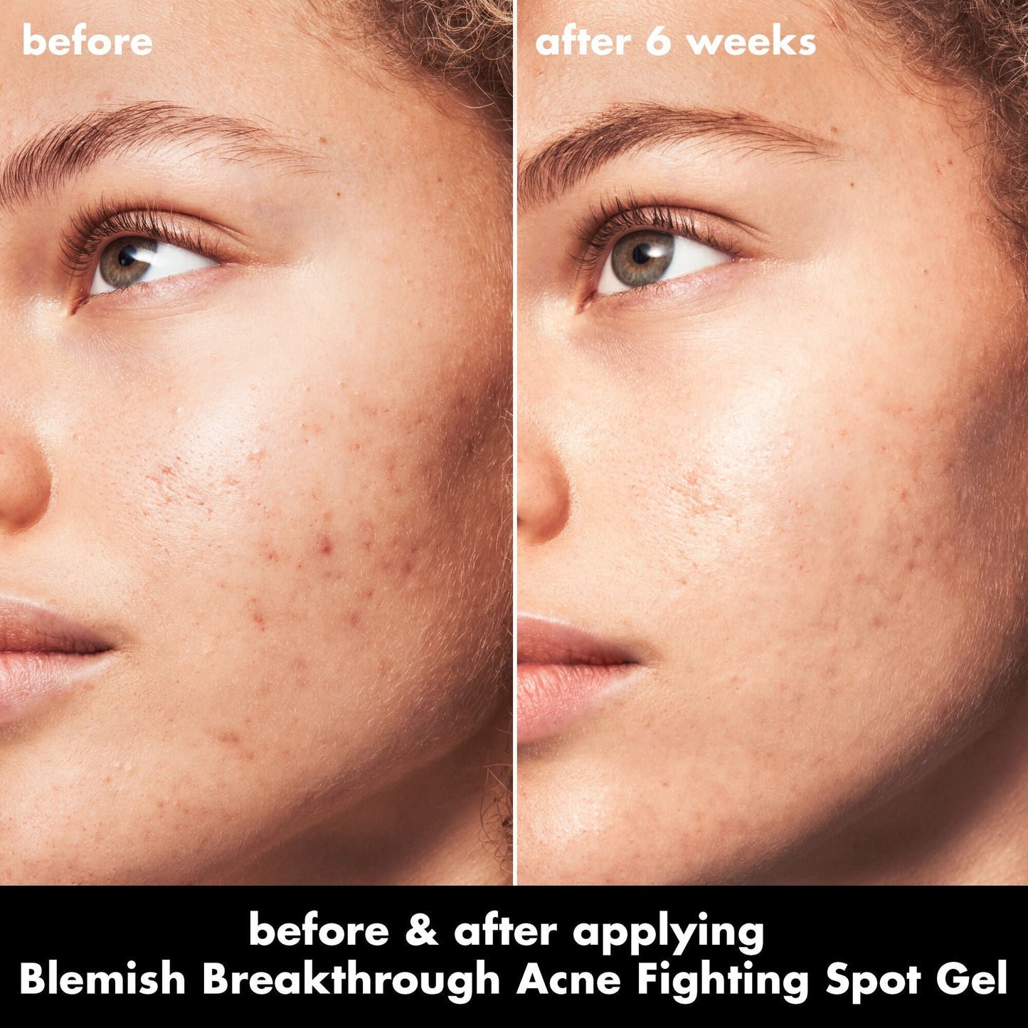 blemish-breakthrough-acne-fighting-spot-gel-n1 0326_EDU_BB_SpotGel_BA_MARLEY.jpg