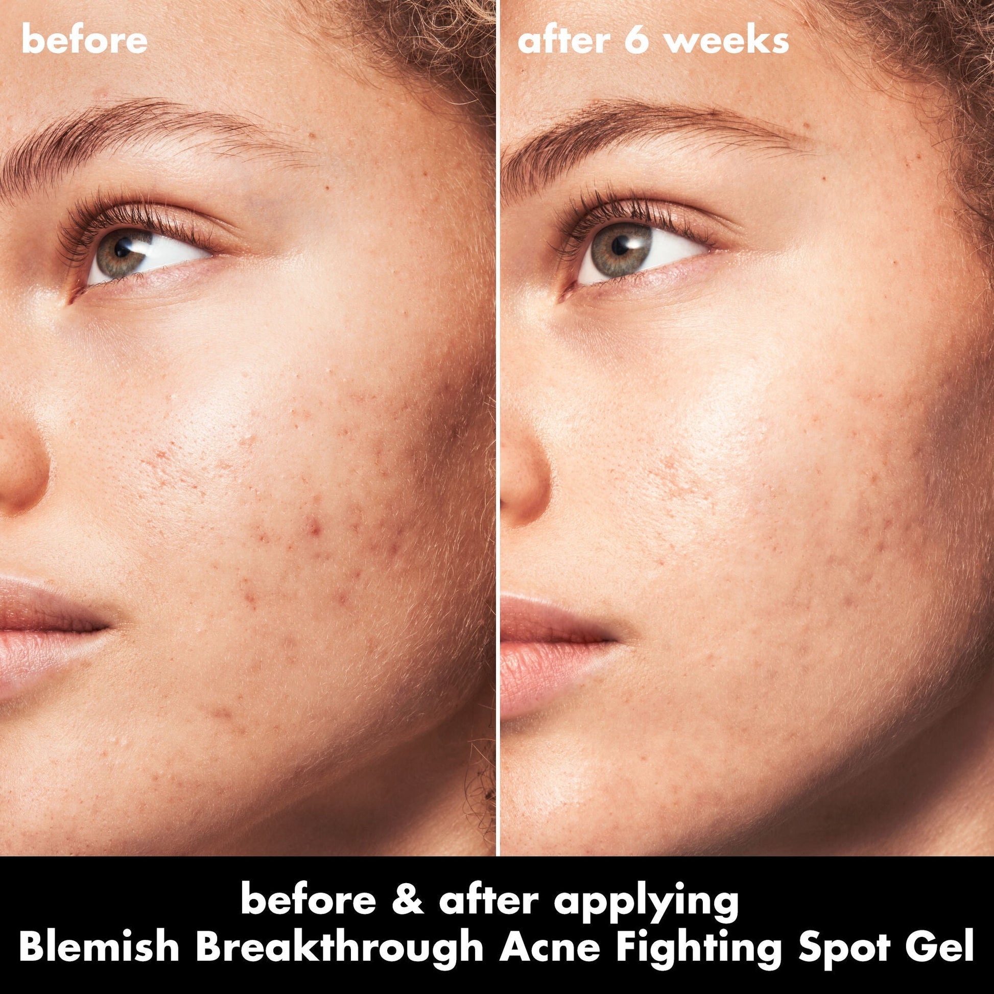 blemish-breakthrough-acne-fighting-spot-gel-n1 0326_EDU_BB_SpotGel_BA_MARLEY.jpg