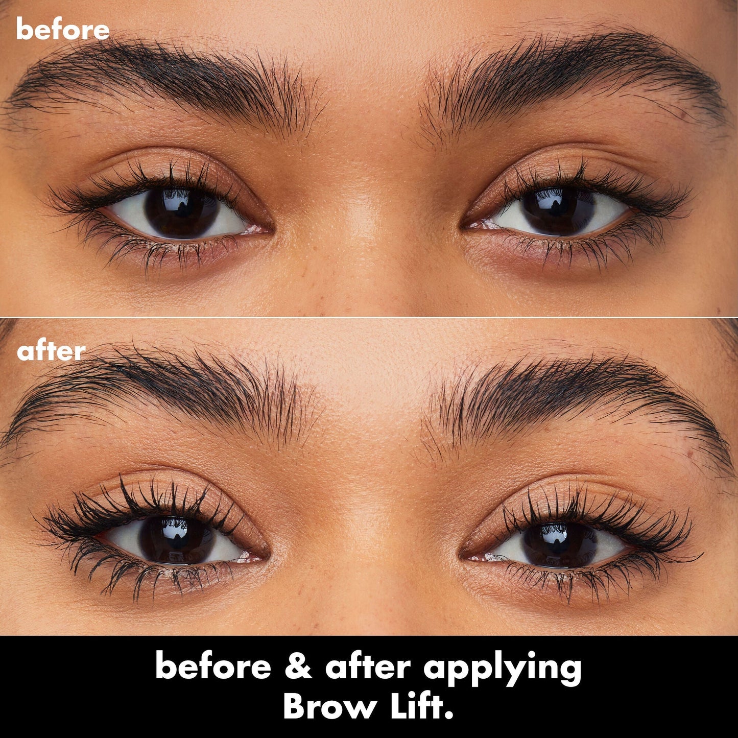 brow-lift-q9 0326_EDU_BrowLift_BA.jpg