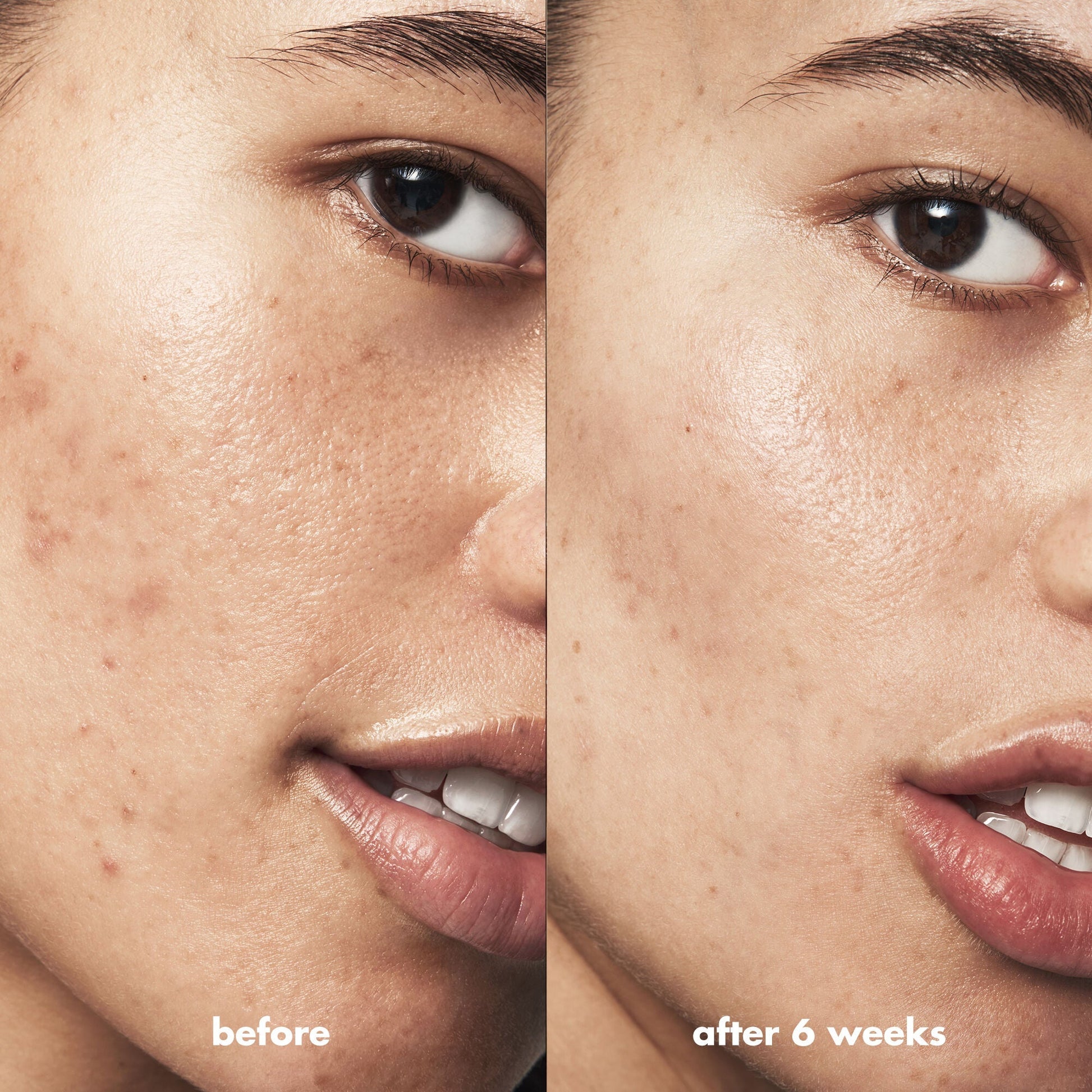 blemish-breakthrough-acne-clarifying-cleanser-q9 Acne_PDP_Isabella_Before_After_a3ff322b-cc6f-4b1a-9db3-bfb66c15d034.jpg