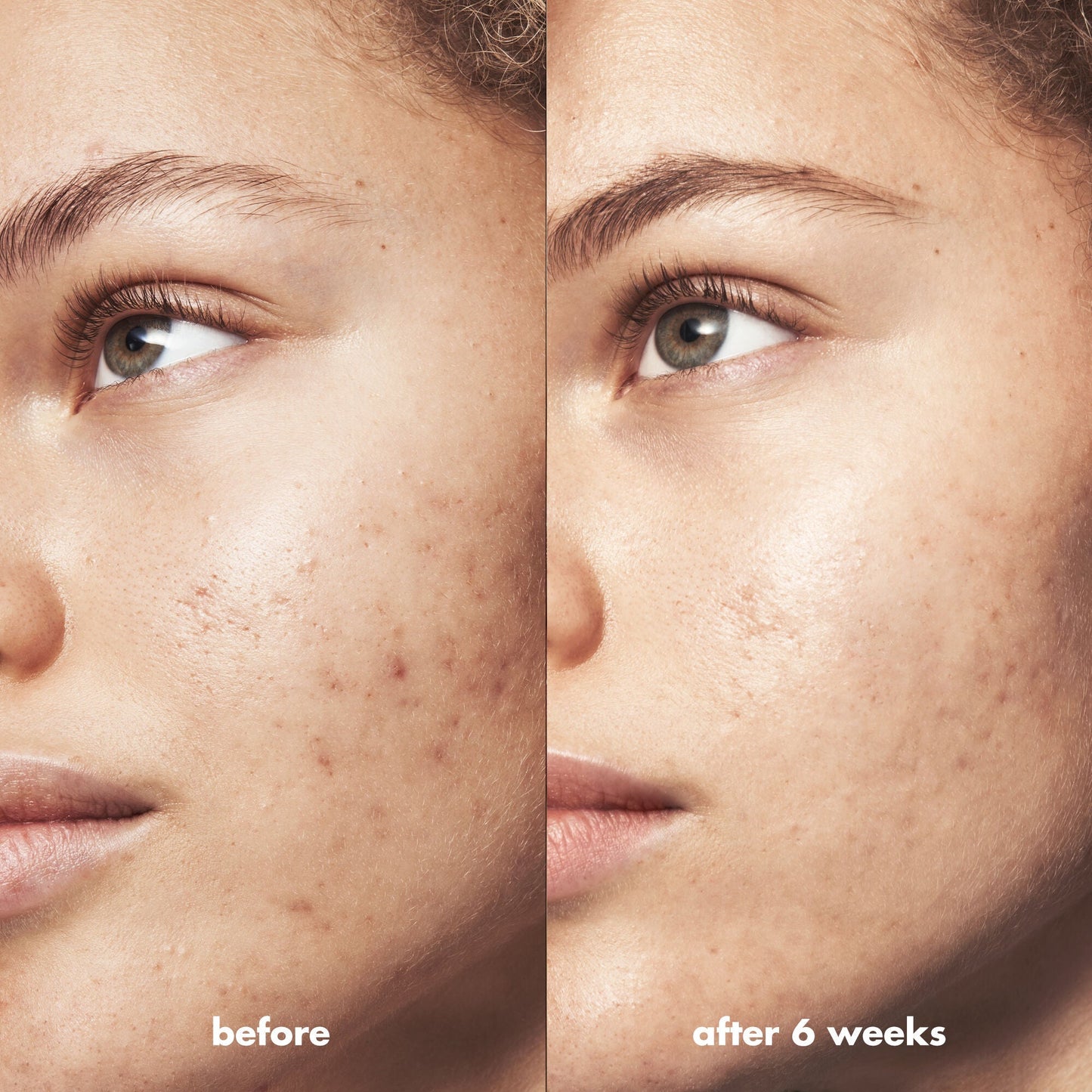 blemish-breakthrough-blemish-control-basics-kit-w4 Acne_PDP_Marley_Before_After_295728d2-6728-4f48-b8ef-c82bbca5b591.jpg